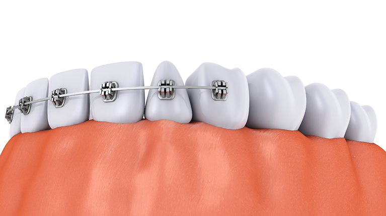 当院の矯正歯科の治療について