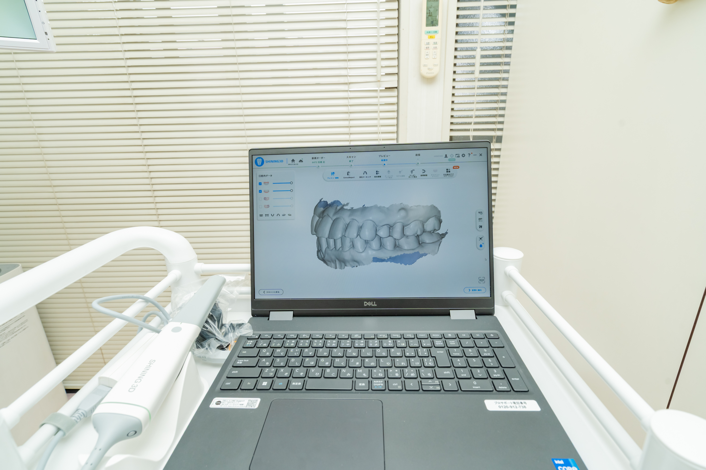 口腔内スキャナー